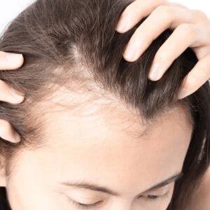 Hair Transplant in Dubai