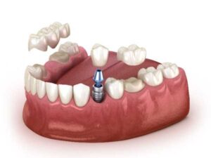 dental implants Twickenham