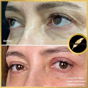 Before and after eyelide surgery