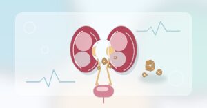 Kidney Stone Symptoms: When to See a Urologist
